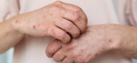 SES orienta população sobre cuidados de prevenção ao Monkeypox