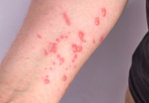 Alerta para novos casos de Mpox é emitido em Mato Grosso