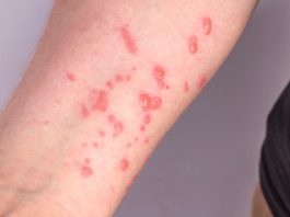 Alerta para novos casos de Mpox é emitido em Mato Grosso