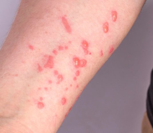 Alerta para novos casos de Mpox é emitido em Mato Grosso