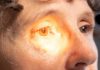 Uso indiscriminado de corticoides pode causar glaucoma e cegueira