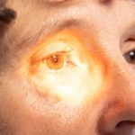 Uso indiscriminado de corticoides pode causar glaucoma e cegueira